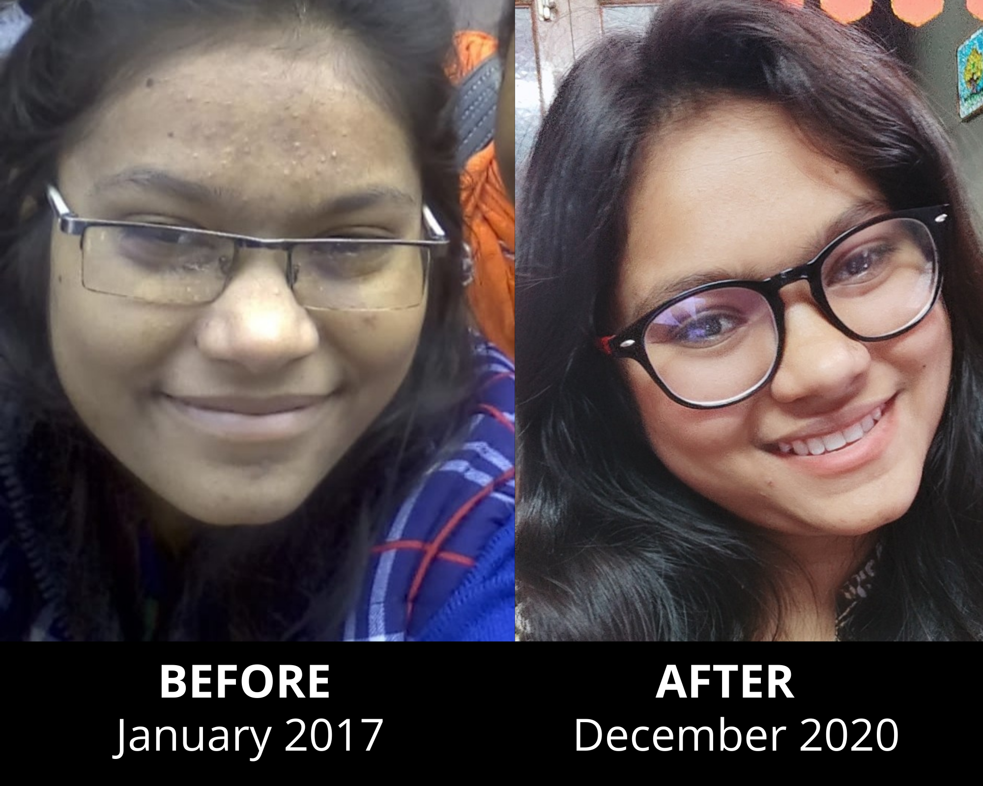 Nitika reverses her 7 year old acne in 1 month