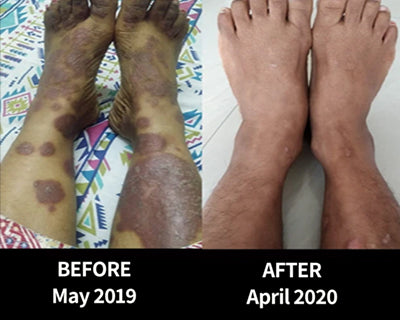Pooja won an intense battle with Psoriasis in 6 months and reclaimed her faith in Mother Nature